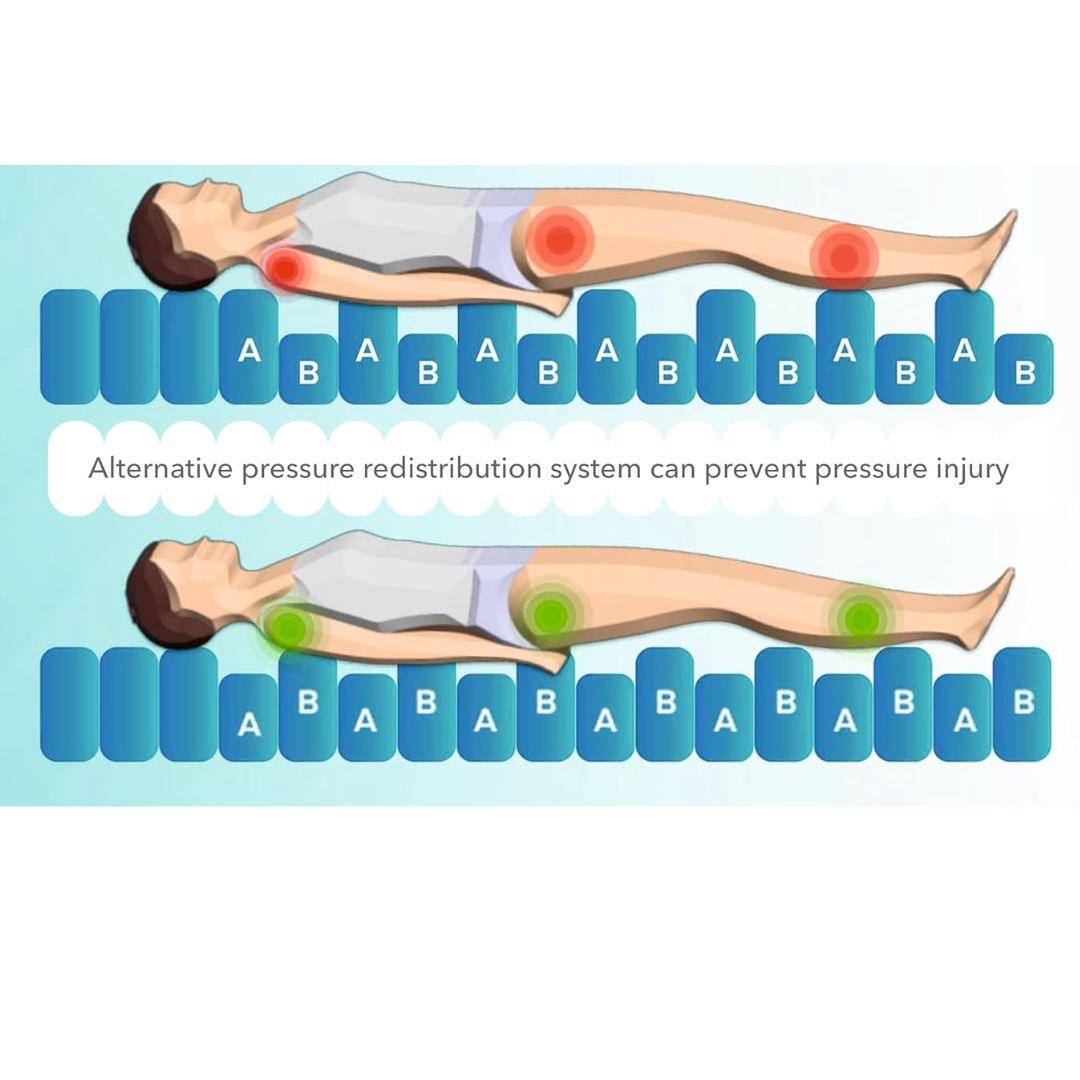 Tubular Air Mattress - Anti Decubitus Mattress with Motor for Bed Sore - AeonCare
